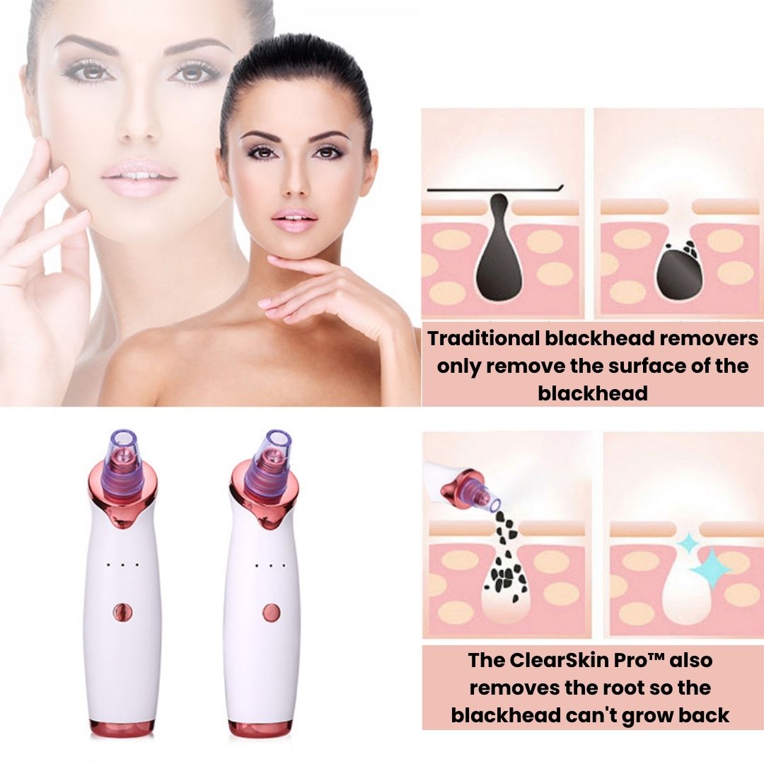 ClearSkin Pro™ Blackhead Remover